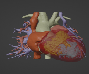 3D Model of Human Heart with Double Superior Vena Cava (DSVC) - generated from real patient