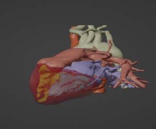 3D Model of Human Heart with Double Outlet Right Ventricle (DORV) - generated from real patient