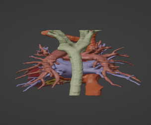 3D Model of Human Heart with Double Aortic Arch (DAA) - generated from real patient