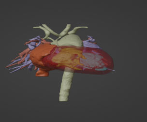 3D Model of Human Heart with Common Arterial Trunk (CAT) - generated from real patient