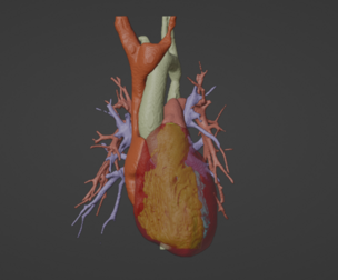 3D Model of Human Heart with Co-Arctation (CA) - generated from real patient