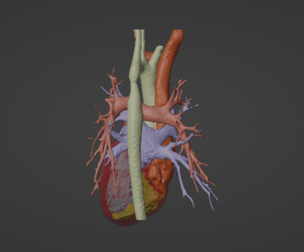 3D Model of Human Heart with Atrio-Ventricular Septal Defect (AVSD) - generated from real patient