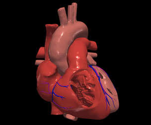 3D Model of Heart with Atrial Septal Defect