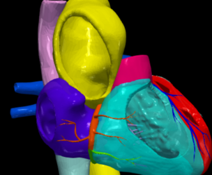 3D Model of Bicuspid Aortic Valve (BAV)