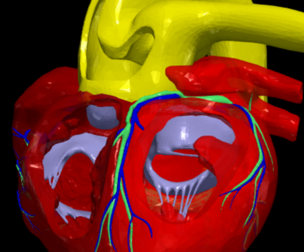 3D Model of Common Arterial Trunk Truncus Arteriosus