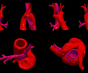 3D Model of Double Aortic Arch