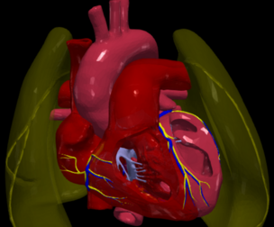 3D Model of Ventricular Septal Defect