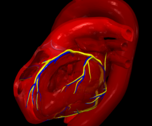 3D Model of Partial Anomalous Pulmonary Venous Connection