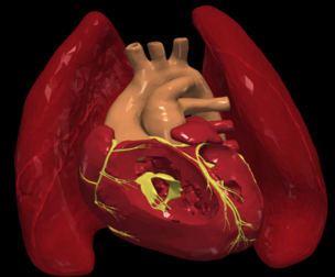 3D Model of Transposition of the Great Arteries Open Duct