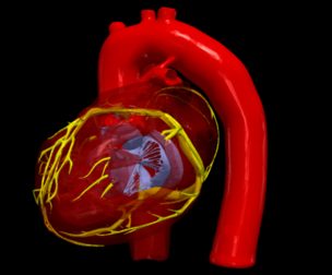 3D Model of Heart with Tetralogy of Fallot (ToF)