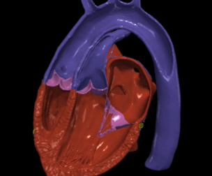 3D Model of Heart with Transposition of the Great Arteries, long axis view