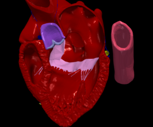 3D Model of Heart wirh Atrioventricular Septal Defect, 4 chamber view