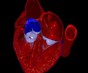 3D Model of the Heart with Tetralogy of Fallot, parasternal long axis