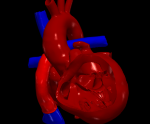 3D Model of Heart after Fontan Procedure