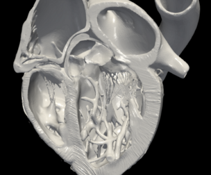 3D Model of Heart (apical 5 chamber plane)