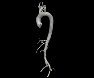 3D Model of Aorta and Aortic Vessel Tree - generated from real patient