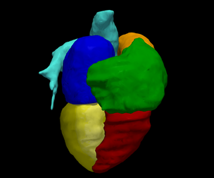 3D Heart Model - generated from real patient