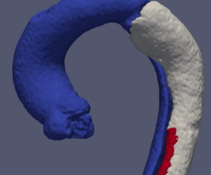 3D Model of Type-B Aortic Dissection (TBAD) - generated from real patient