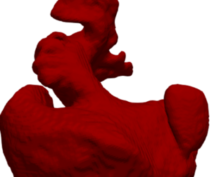 3D Model of Left Atrial Appendage - generated from real patient