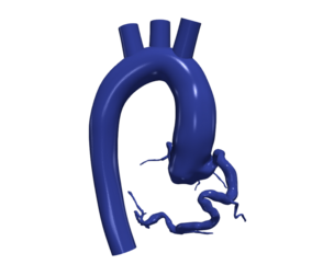 3D Model of Aorta and Coronary Arteries