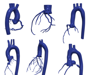 3D Model of Aorta and Coronary Arteries - 6pack