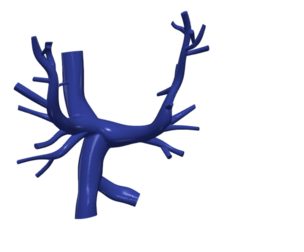 3D Model of Pulmonary Arteries (Fontan Procedure)