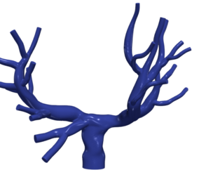 3D Model of Pulmonary Arteries (Fontan Procedure)