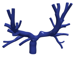 3D Model of Pulmonary Arteries (Fontan Procedure)