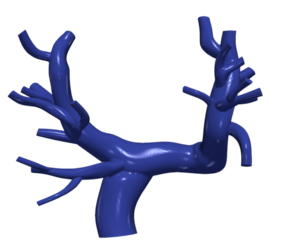 3D Model of Pulmonary Arteries (Fontan Procedure)