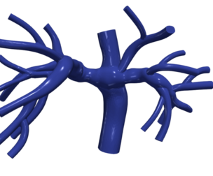 3D Model of Pulmonary Arteries (Fontan Procedure)
