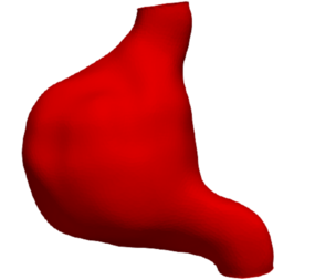 Model of an abdominal aortic aneurysm from a real patient