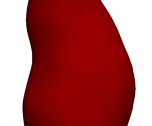 Model of an abdominal aortic aneurysm from a real patient