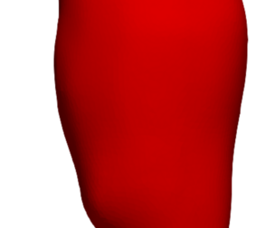 Model of an abdominal aortic aneurysm from a real patient