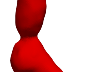 Model of an abdominal aortic aneurysm from a real patient