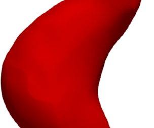 Model of an abdominal aortic aneurysm from a real patient