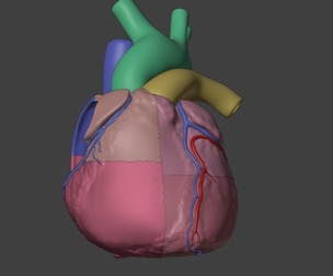 3D Model of Heart with Atrial Septal Defect
