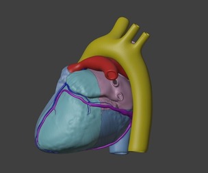 3D Model of Heart with Tetralogy of Fallot