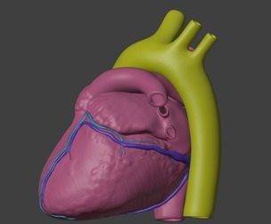 3D Model of Heart with Double Outlet Right Ventricle