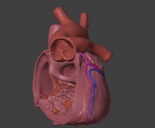 3D Model of Heart with Truncus Arteriosus