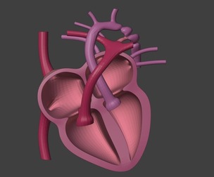 3D Model of Heart with Coarctation of Aorta