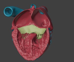3D Model of Heart with Atrioventricular Septal Defect (4-chamber view)