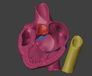 3D Model of Heart with Atrioventricular Septal Defect - PSLAX