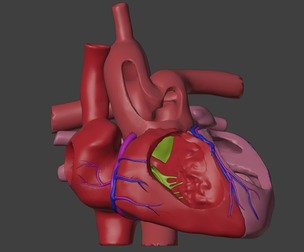 3D Model of Heart with Common Arterial Trunk Truncus Arteriosus