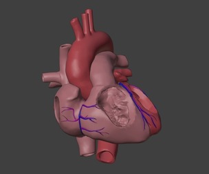 3D Model of Heart with Partial Anomalous Pulmonary Venous Connection
