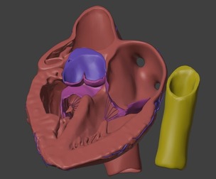 3D Model of Heart with Tetralogy of Fallot - long axis