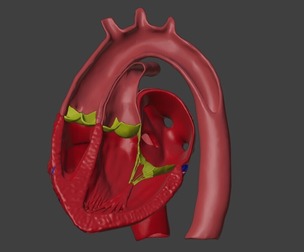3D Model of Heart with Transposition of the Great Arteries - long-axis