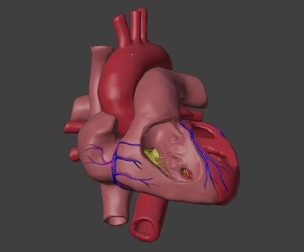 3D Model of Heart with Ventricular Septal Defect