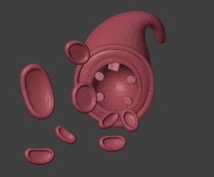 3D Model of Artery with Atherosclerosis