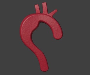 3D Model of Aorta with Aneurysm