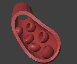 3D Model of Artery with Atherosclerosis